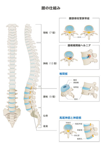 椎間板ヘルニア　脊柱管狭窄症